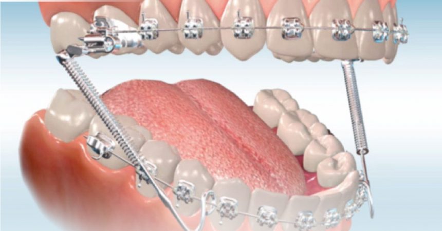 Tác-Dụng-Của-Lò-Xo-Trong-Quá-Trình-Chỉnh-Nha